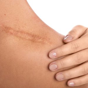 Leczenie i terapia blizn - fizjoterapia